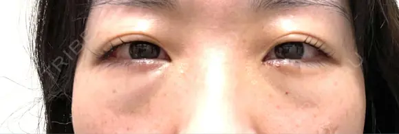 クマ治療 湘南美容クリニック 千葉センシティ院 BEFORE メイン用