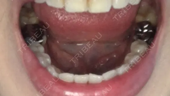 セラミック 東京美容外科 赤坂院 BEFORE メイン用