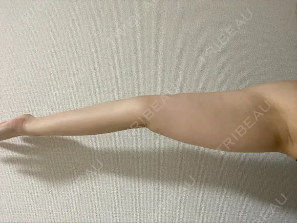 脂肪吸引（二の腕） / 脂肪吸引（肩） Mods Clinic（モッズクリニック） 大阪院 BEFORE メイン用