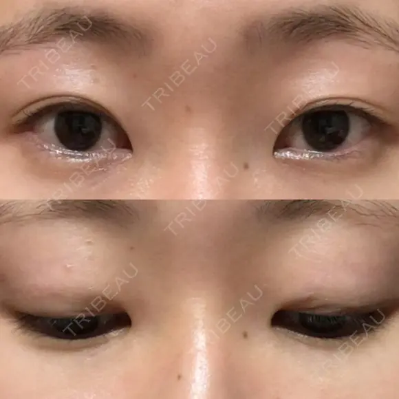 二重切開 表参道スキンクリニック 表参道院 BEFORE メイン用