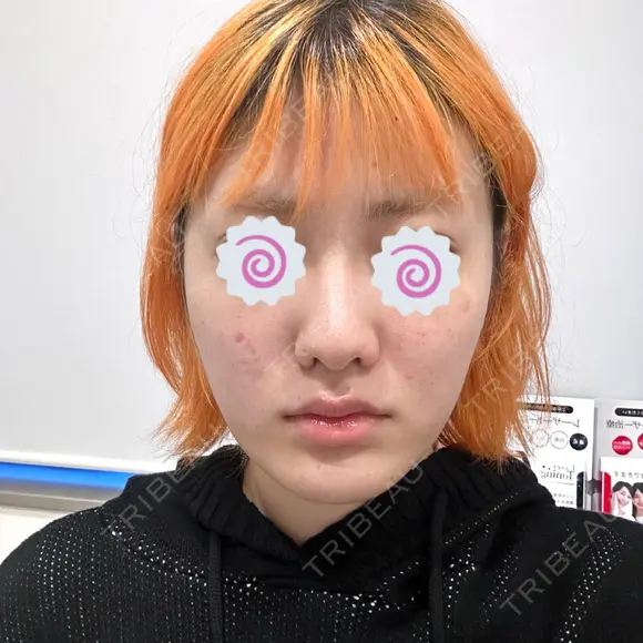 切開リフト 東京エビスクリニック BEFORE メイン用