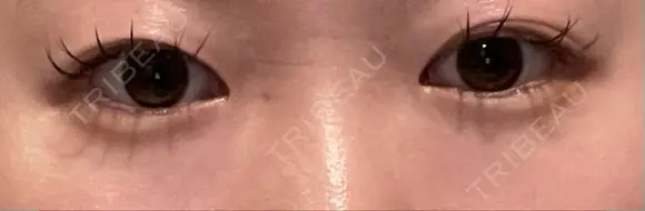 二重切開 Olino美容外科・美容皮膚科 BEFORE メイン用