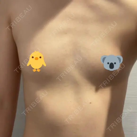 豊胸（脂肪注入） 銀座マイアミ美容外科 BEFORE メイン用