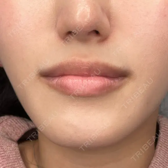 アートメイク（唇） Brandnew Beauty Clinic BEFORE メイン用