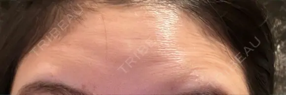 ボトックス（エラ・小顔） / ボトックス（眉間） / ボトックス（額） 湘南美容クリニック 新宿本院 BEFORE メイン用