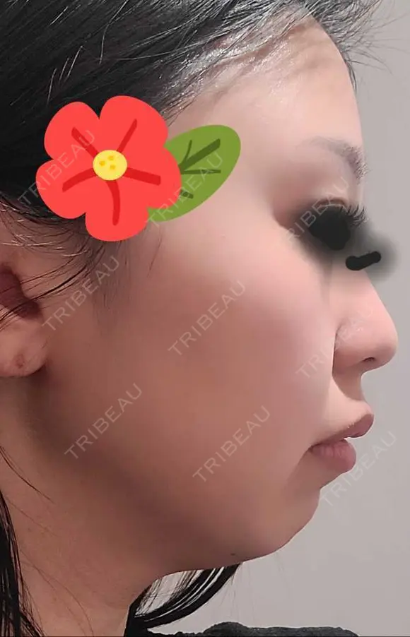ヒアルロン酸注入（あご） / シワ取りボトックス ブルームクリニック（BLOOM CLINIC） BEFORE メイン用