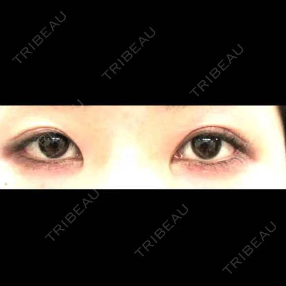 目頭切開 アリエル美容クリニック 郡山院 BEFORE メイン用
