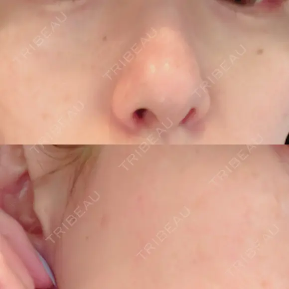 ルビーレーザー S-Laboクリニック 渋谷院 BEFORE メイン用