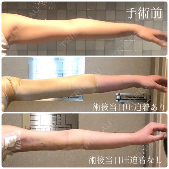 脂肪吸引（二の腕） ヨンセスリムライン BEFORE メイン用