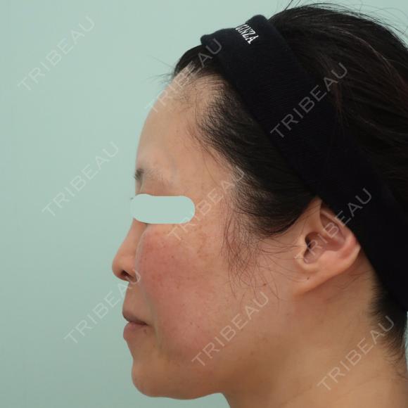 鼻尖形成（切開） / 鼻中隔延長（切開） / 軟骨移植 WOM CLINIC GINZA （ワム クリニック ギンザ） BEFORE メイン用