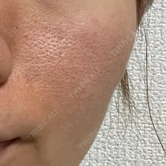 ニードルRF（ポテンツァなど） 美容皮膚科エルムクリニック 大阪院 BEFORE メイン用