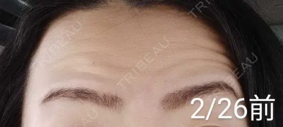 ボトックス（眉間） / ボトックス（額） / その他（鼻） 湘南美容クリニック 宇都宮院 BEFORE メイン用