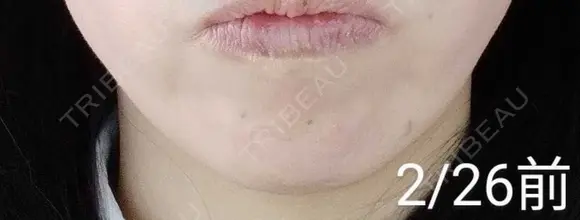 ボトックス（あご） 湘南美容クリニック 宇都宮院 BEFORE メイン用