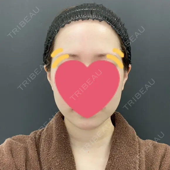 脂肪吸引（顔） BLINC CLINIC （ブリンク クリニック） BEFORE メイン用