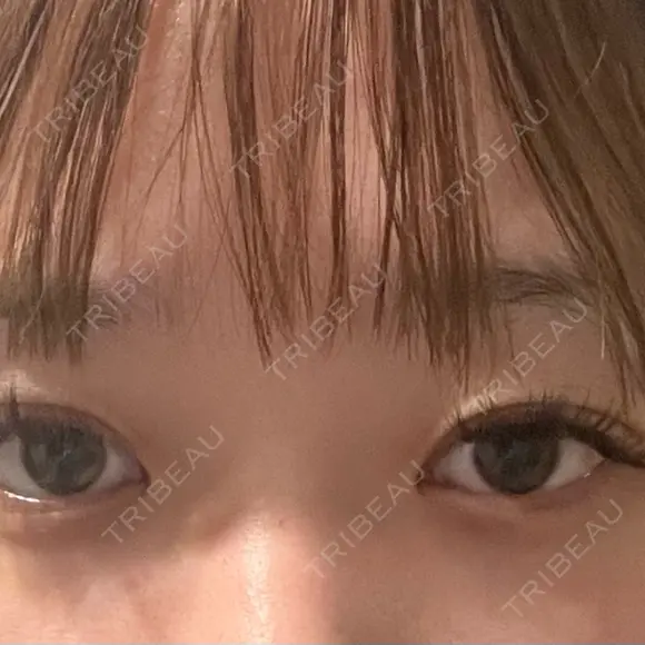 二重埋没 / 目頭切開 / 糸リフト / 脂肪吸引（顔） / ヒアルロン酸注入（涙袋） R Beauty CLINIC 名古屋院 BEFORE メイン用