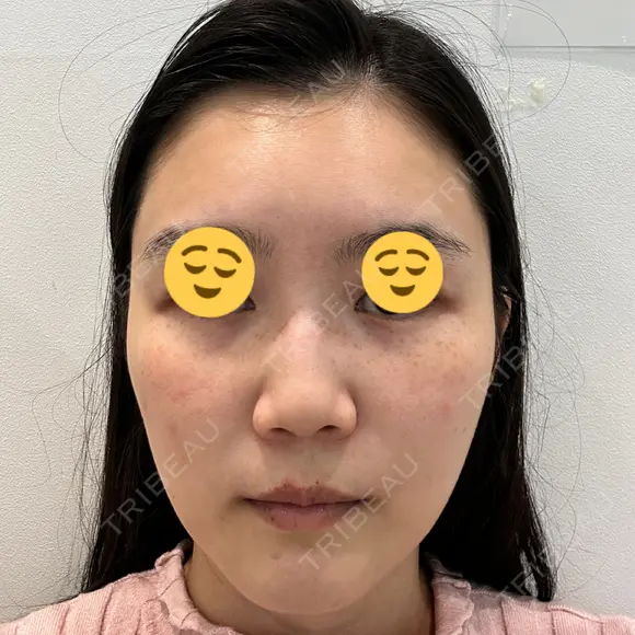 エレクトロポレーション / 光治療（フォトフェイシャルなど） DMTC CLINIC 日本橋院 BEFORE メイン用