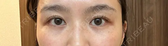 ボトックス（目尻） スキンリファインクリニック銀座 BEFORE メイン用
