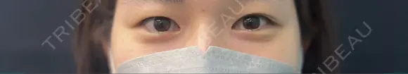 二重埋没 湘南美容クリニック 千葉センシティ院 BEFORE メイン用