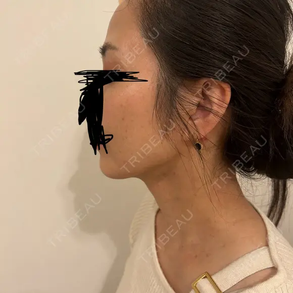 脂肪注入（額） Mods Clinic（モッズクリニック） 福岡院 BEFORE メイン用