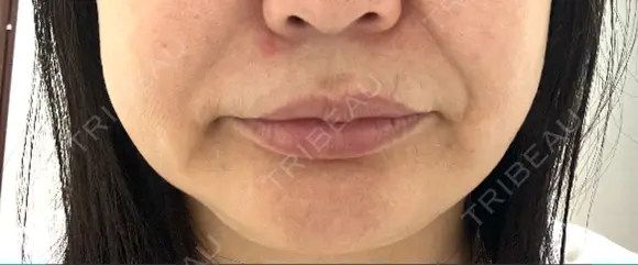 ボトックス（口角） / ボトックス（人中） S-Laboクリニック 渋谷院 BEFORE メイン用