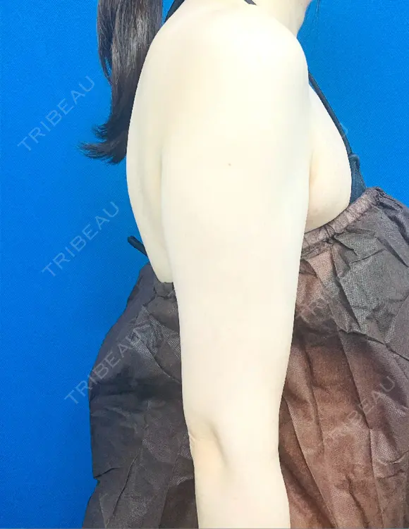 脂肪吸引（二の腕） / その他（胸） / 脂肪吸引（肩） 湘南美容クリニック 渋谷院 BEFORE メイン用