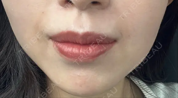 ヒアルロン酸注入（鼻翼基部） ルラ美容クリニック 名古屋本院 BEFORE メイン用