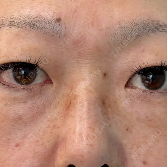 下まぶたたるみ取り / 下まぶたの脂肪取り / 脂肪注入（目の下） 湘南美容クリニック 千葉センシティ院 BEFORE メイン用