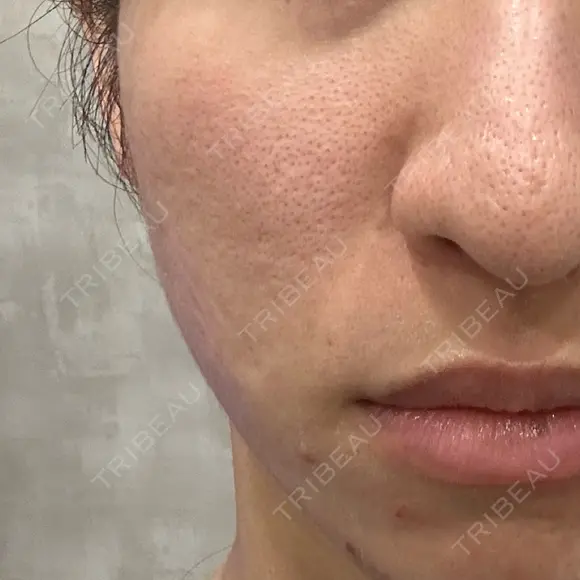 その他（肌） / 毛穴洗浄（ハイドラフェイシャルなど） / ニキビ治療 AURORA CLINIC（オーロラクリニック）新宿院 BEFORE メイン用