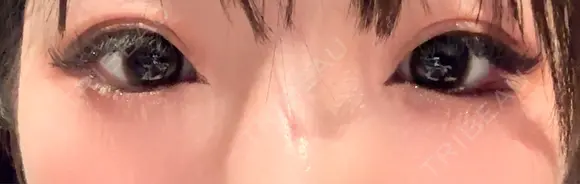 ヒアルロン酸注入（涙袋） ファイヤークリニック 新宿院 BEFORE メイン用