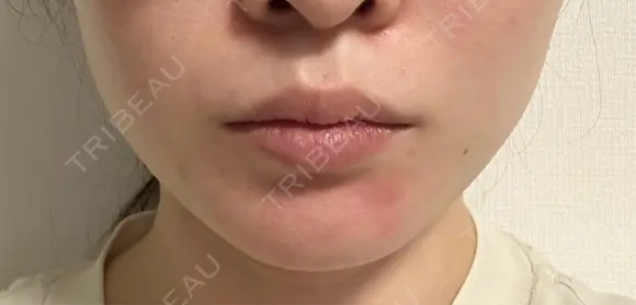 ボトックス（エラ・小顔） / その他（輪郭） L‘amour clinic Tokyo【ラムールクリニック東京】 BEFORE メイン用