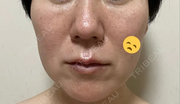 シミ取りレーザー / ピコスポット Olino美容外科・美容皮膚科 BEFORE メイン用