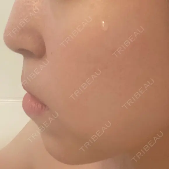 ヒアルロン酸注入（唇） / ボトックス（口角） / ヒアルロン酸注入（頬） / イオン導入 / ルメッカ ルラ美容クリニック 大宮院 / ルラスキンクリニック 大宮院 BEFORE メイン用