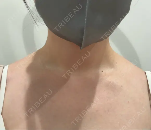 ボトックス（肩） おおかみ美容のクリニック 新宿院 BEFORE メイン用