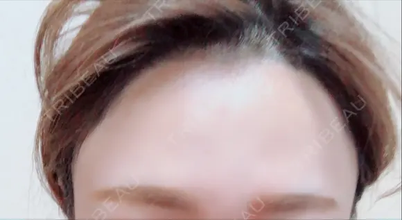 脂肪注入（肌） / 再生医療 / PRP皮膚再生療法 iSTAR美容外科・皮膚科 BEFORE メイン用