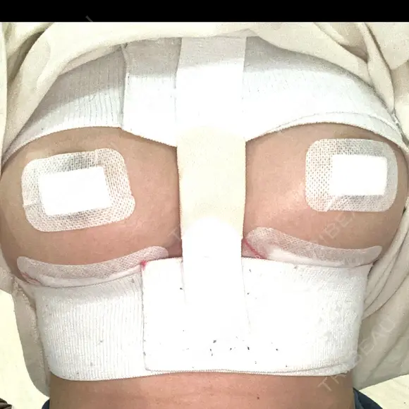 豊胸（シリコンバッグ） / ワキ汗治療（ボトックス） お茶の水美容形成クリニック BEFORE メイン用