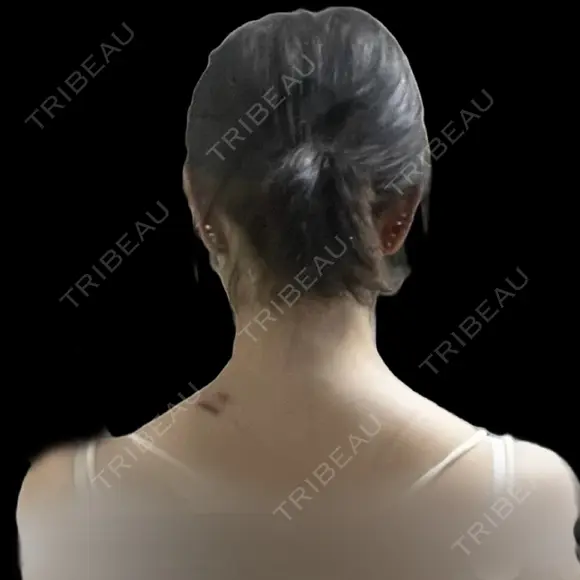 ボトックス（あご） / ボトックス（肩） ルラ美容クリニック 札幌本院 BEFORE メイン用