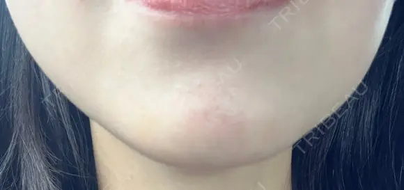 ボトックス（あご） ルラ美容クリニック 名古屋本院 BEFORE メイン用