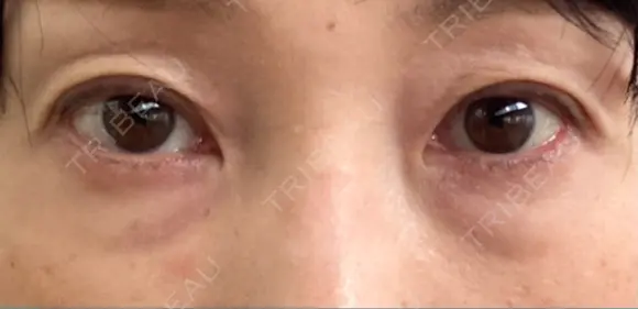 下まぶたの脂肪取り / 脂肪注入（肌） / 脂肪注入（目の下） X CLINIC 大阪院 BEFORE メイン用