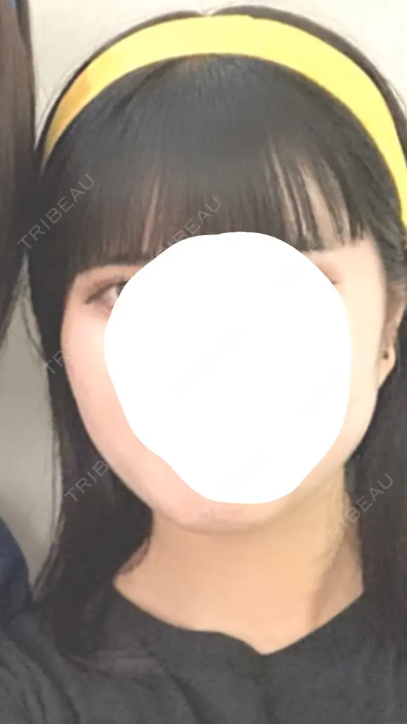 ボトックス（エラ・小顔） さっぽろ美容クリニック BEFORE メイン用