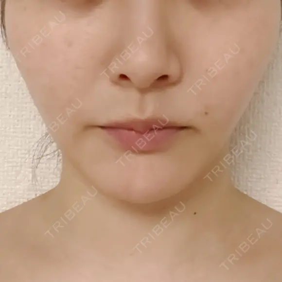 ピコスポット L‘amour clinic Tokyo【ラムールクリニック東京】 BEFORE メイン用