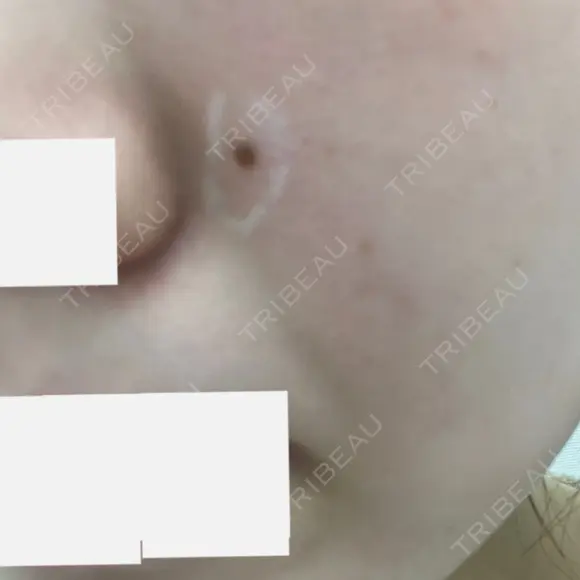 ほくろ・いぼ除去レーザー（肌） フェアクリニック川口 BEFORE メイン用