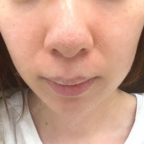 ヴェルヴェットスキン 東京シンデレラ美容外科 大宮院 BEFORE メイン用