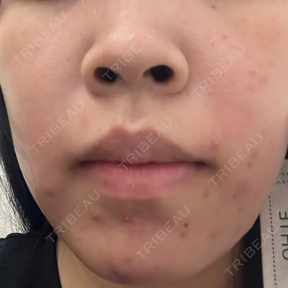 ポテンツァ 渋谷美容外科クリニック 横浜院 BEFORE メイン用