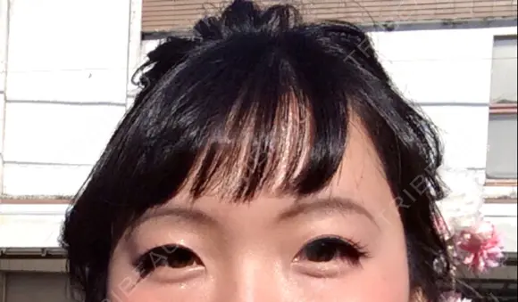 二重埋没 / その他（目元） TCB東京中央美容外科 四日市院 BEFORE メイン用