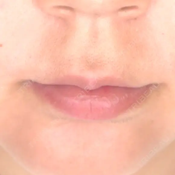 ヒアルロン酸注入（唇） / ボトックス（口角） ルラ美容クリニック 札幌本院 BEFORE メイン用