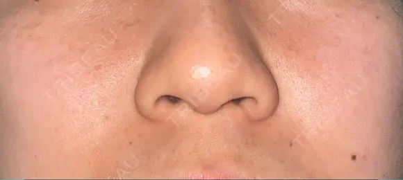 ルメッカ Belle Via Skin Clinic BEFORE メイン用