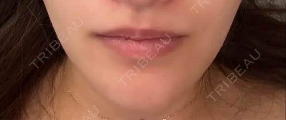 骨切り（あご） / 脂肪吸引（顔） / ジョールファット除去 銀座マイアミ美容外科 BEFORE メイン用