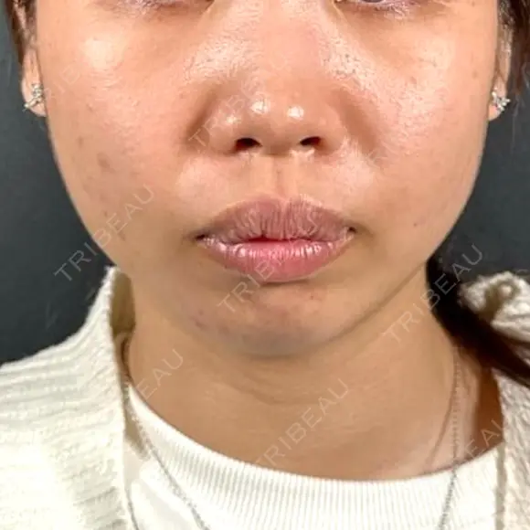 隆鼻術 / 鼻尖形成（切開） / 脂肪吸引（顔） / 軟骨移植 / メーラーファット除去 R Beauty CLINIC 名古屋院 BEFORE メイン用