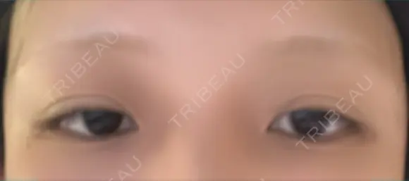 二重埋没 / ヒアルロン酸注入（涙袋） TCB東京中央美容外科 岡山院 BEFORE メイン用
