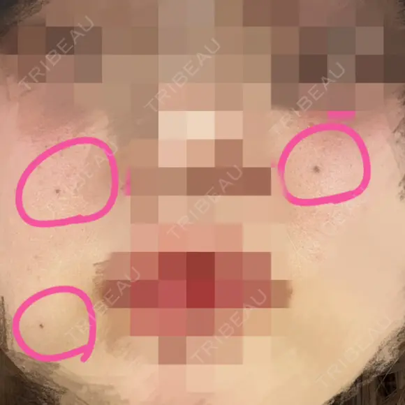 ほくろ・いぼ切除（肌） Jスキンクリニック 【J-SKIN clinic】 BEFORE メイン用
